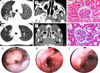 Case Report: Activating PIK3CD Mutation in Patients Presenting With Granulomatosis With Polyangiitis